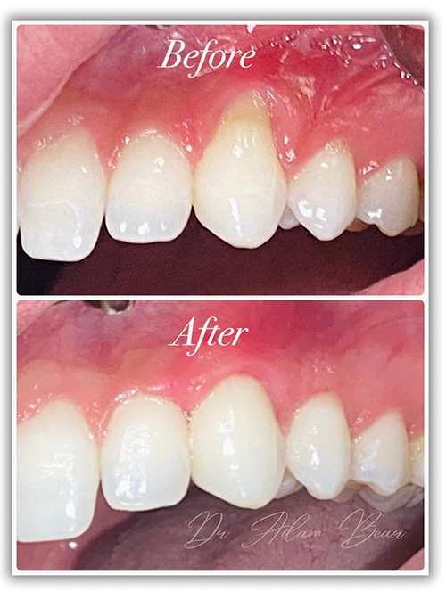 Adam L. Bear, DDS, PLLC | Frenectomy, Types of Periodontal Disease and Sinus Augmentation