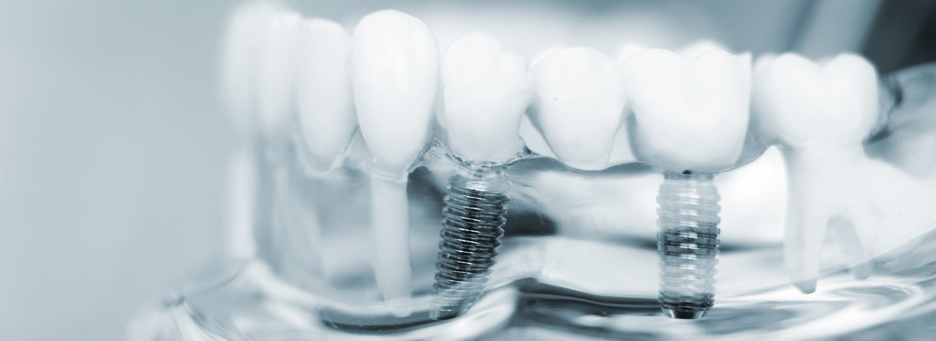 Adam L. Bear, DDS, PLLC | Crown Lengthening, Treatment of Periodontal Disease and Nitrous Oxide